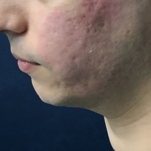 1 mans profile, before microneedling treatment acne scarring