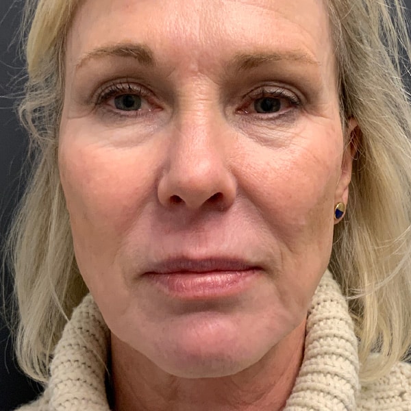 After Microneedling Facial