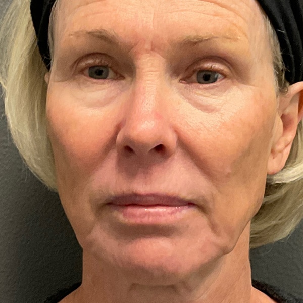 Before Microneedling Facial