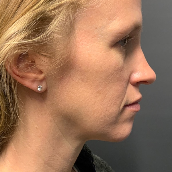 Before full face filler