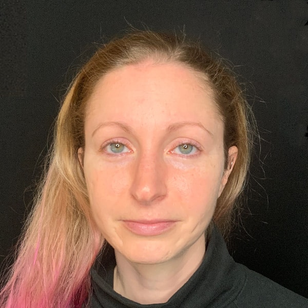 Before Nonsurgical Hair Restoration