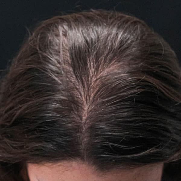 After Nonsurgical Hair Restoration