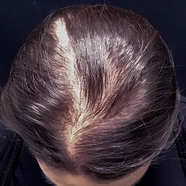 Before Nonsurgical Hair Restoration