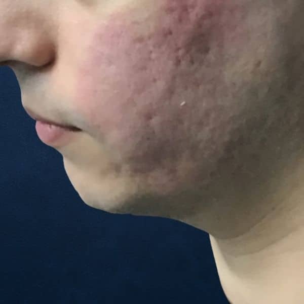 1 mans profile, before microneedling treatment acne scarring