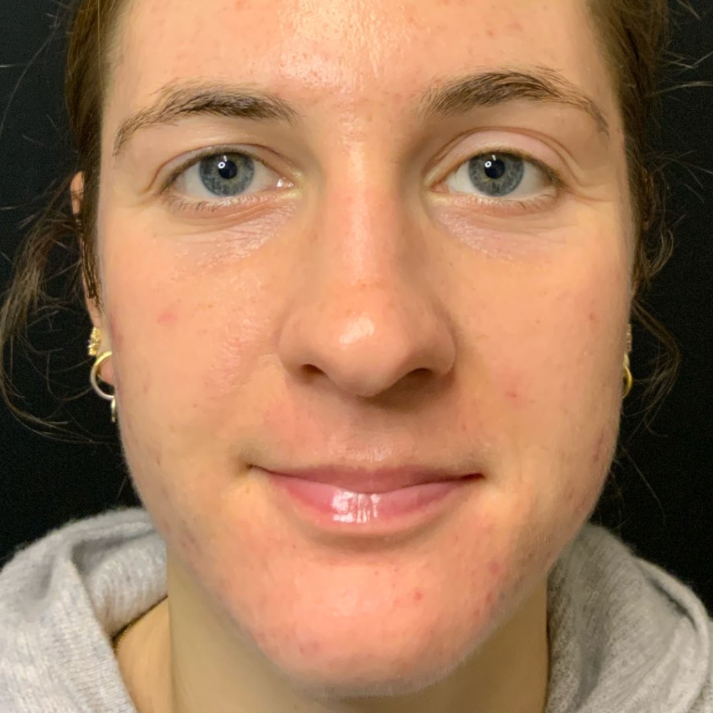 after acne treatments at rejuvenationmd after acne treatments at rejuvenationmd