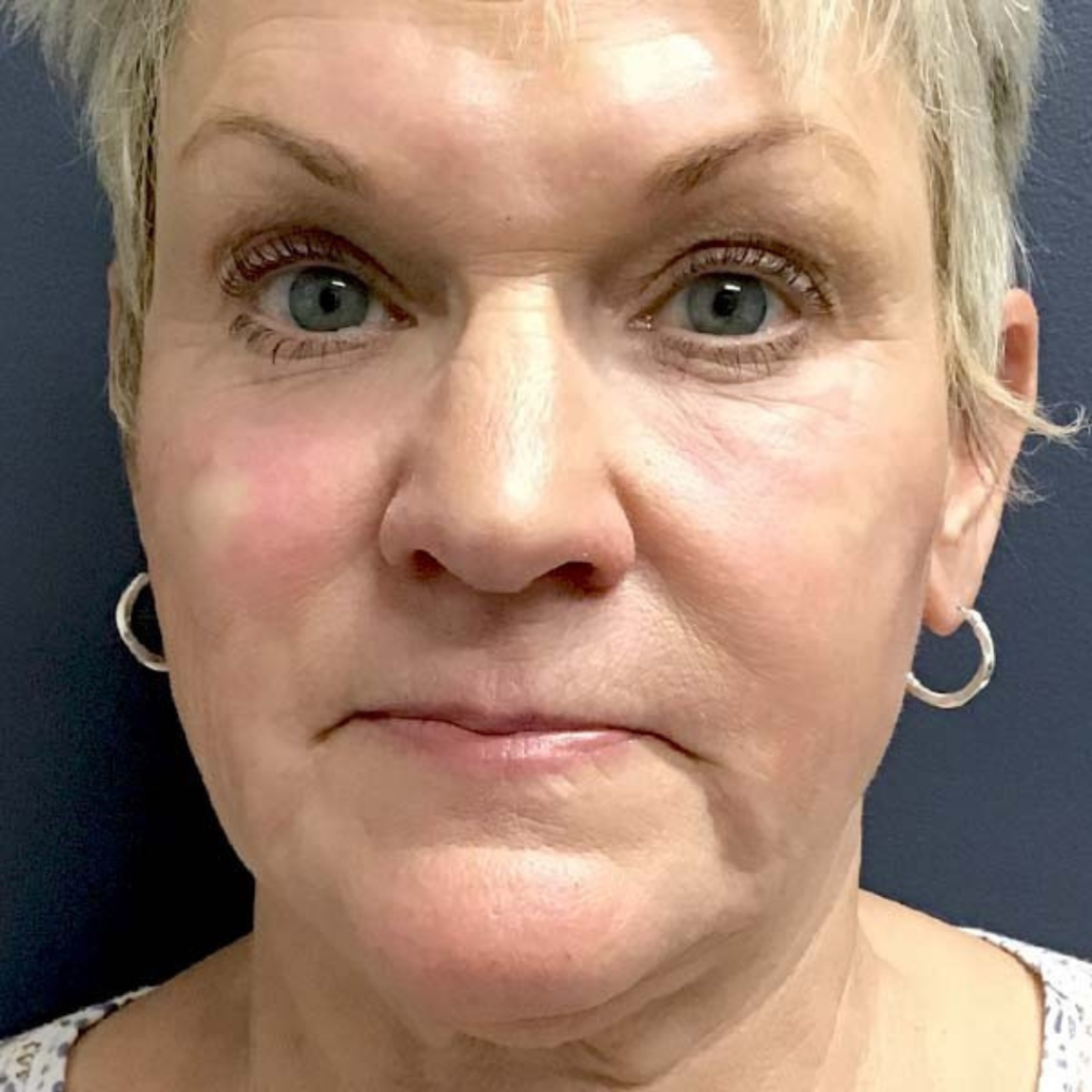 After nonsurgical facelift at RejuvenationMD after