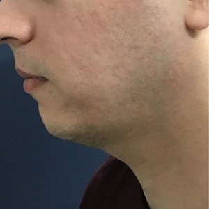 post 2 microneedling mans profile, after microneedling acne scarring is gone
