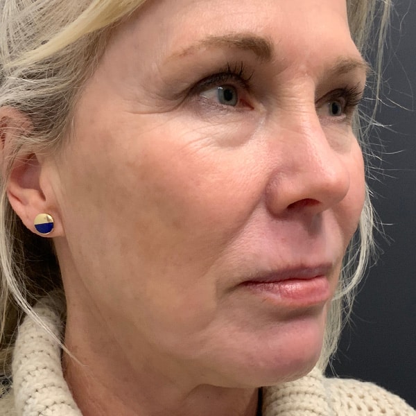 After Microneedling Facial