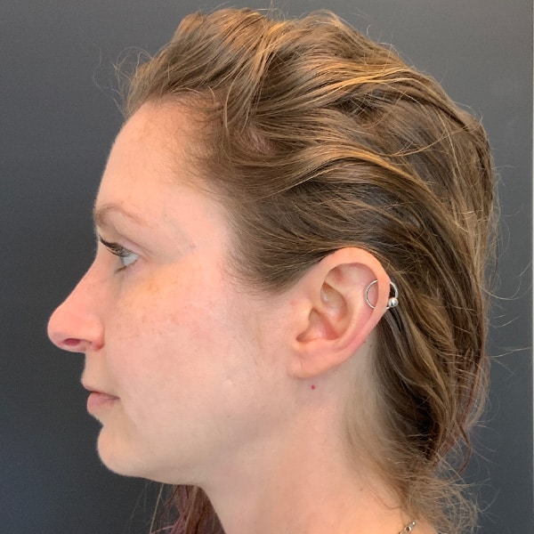 After Nonsurgical Hair Restoration