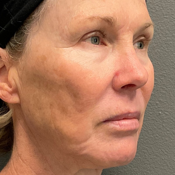 Before Microneedling Facial