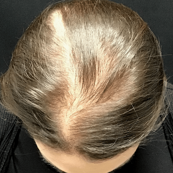 2-Before-Nonsurgical-Hair-Restoration- Before Nonsurgical Hair Restoration