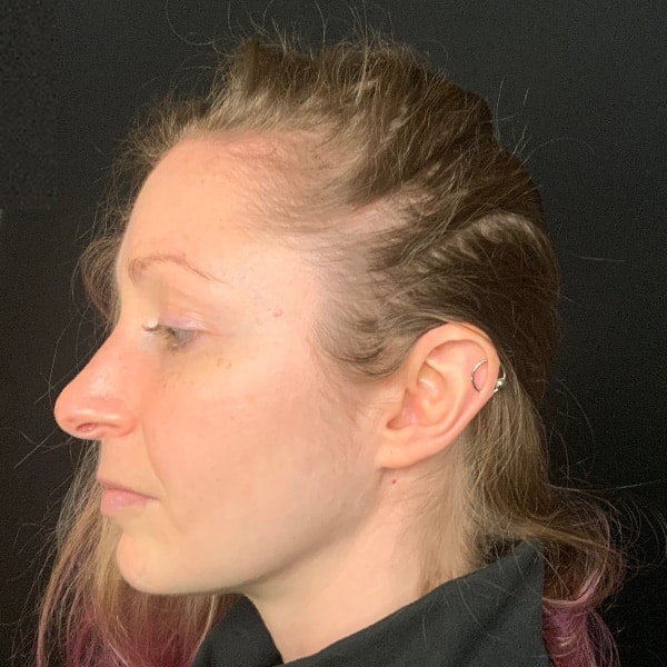 Before Nonsurgical Hair Restoration