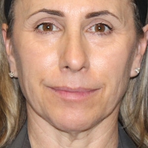 2- Plasma Pen AFTER woman with tighter, lifted skin around her eyes after plasma pen