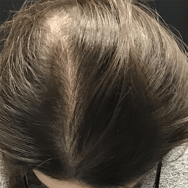 2-Post-Nonsurgical-Hair-Restoration- After Nonsurgical Hair Restoration