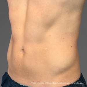 3-After CoolTone Tone male abs after 4 CoolTone Treatments