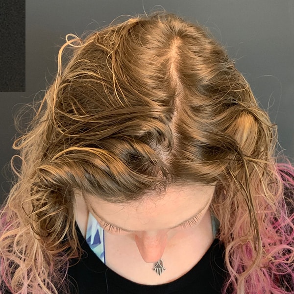 After Nonsurgical Hair Restoration