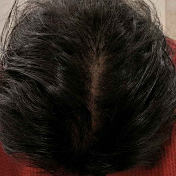3-After-Nonsurgical-Hair-Restoration after