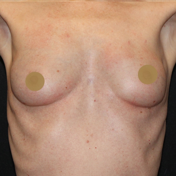 After-Nonsurgical-Breast-Lift