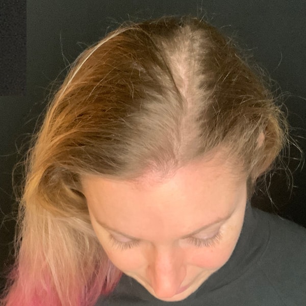 Before Nonsurgical Hair Restoration