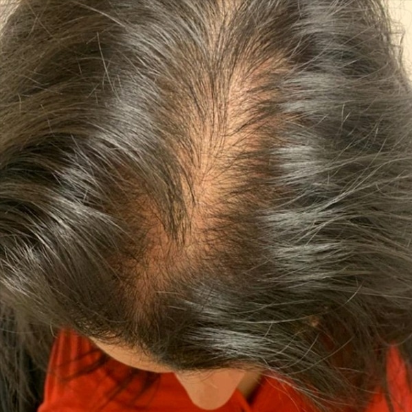 3-Before-Nonsurgical-Hair-Restoration severely thin hair on top of a woman's head before nonsurgical hair restoration treatment