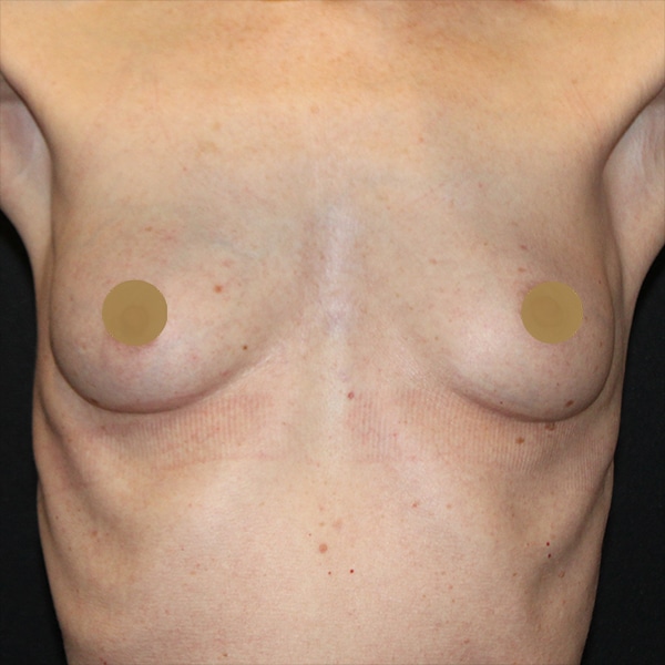 Before-Nonsurgical-Breast-Lift