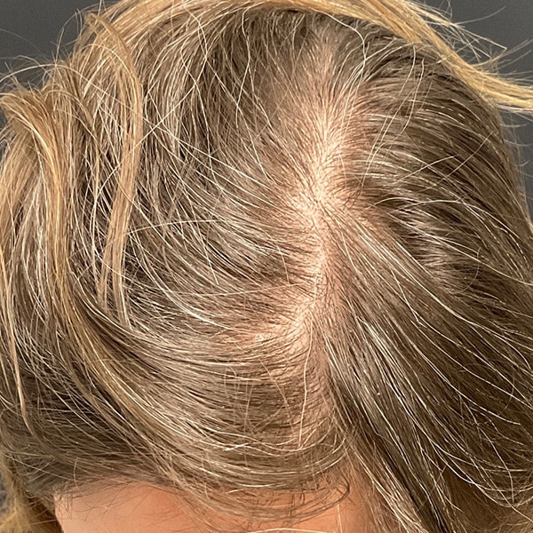 After Nonsurgical Hair Restoration