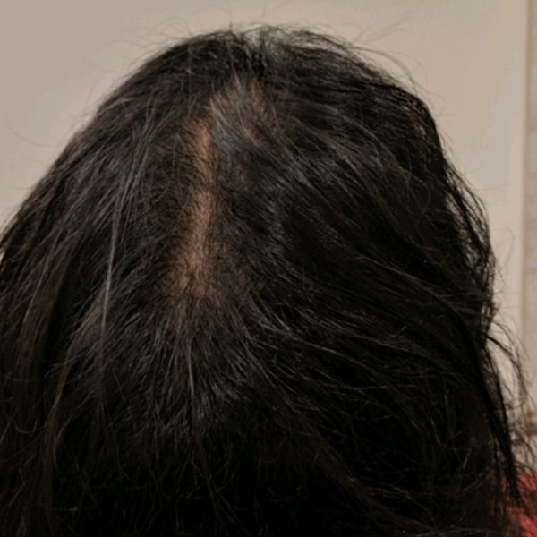 After Nonsurgical Hair Restoration