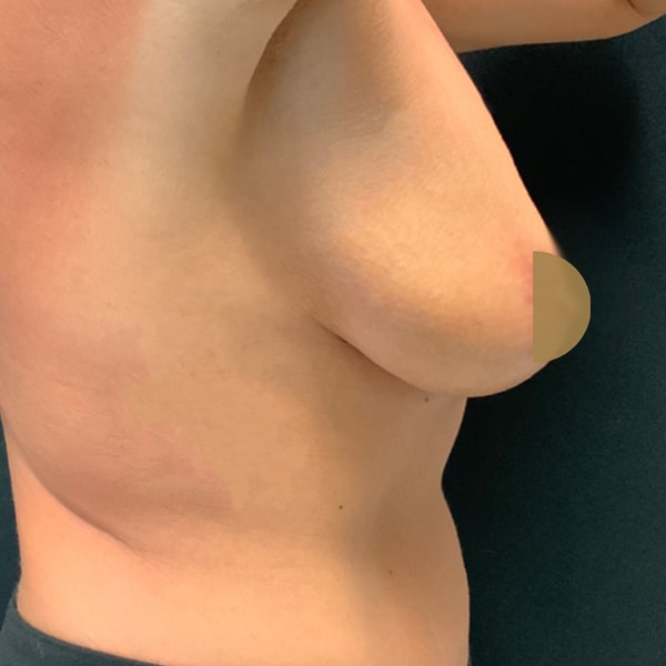 After-Nonsurgical-Breast-Lift