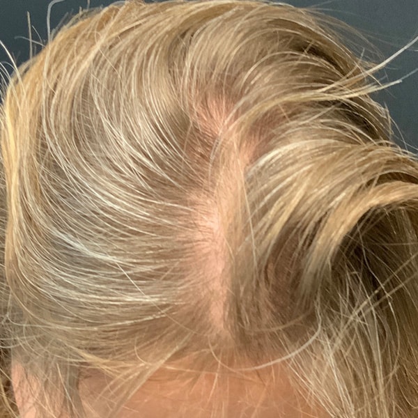 Before Nonsurgical Hair Restoration
