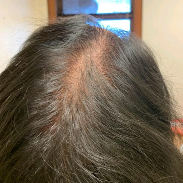 Before Nonsurgical Hair Restoration