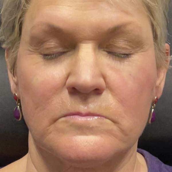 After Nonsurgical Facelift
