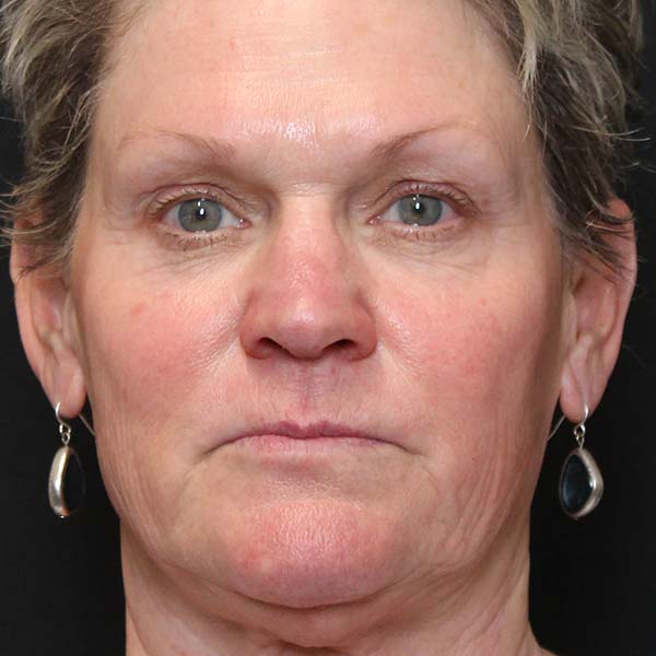 Before Nonsurgical Facelift