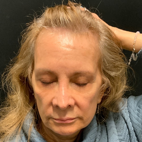 Before Nonsurgical Hair Restoration