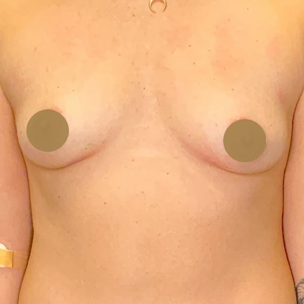After-Nonsurgical-Breast-Lift