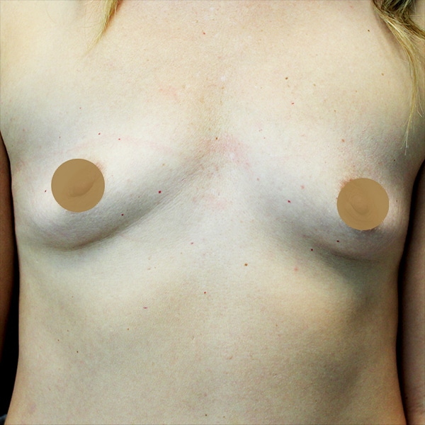 Before-Nonsurgical-Breast-Lift