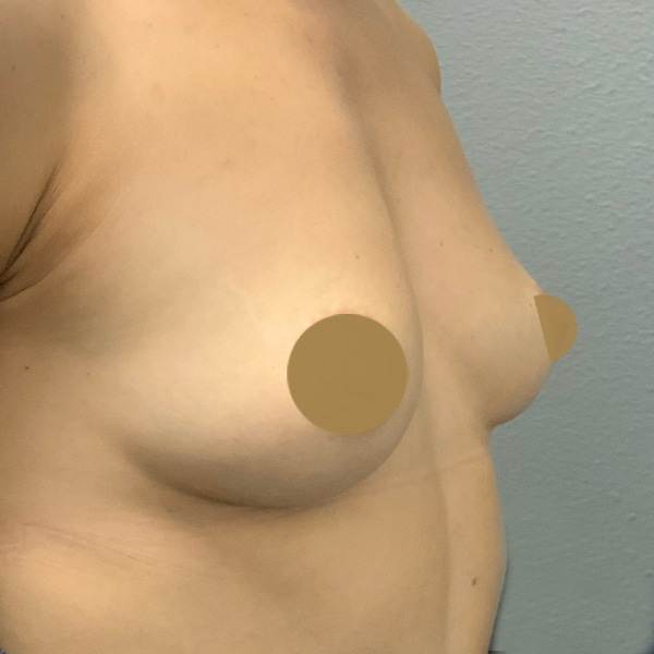 Before-Nonsurgical-Breast-Lift
