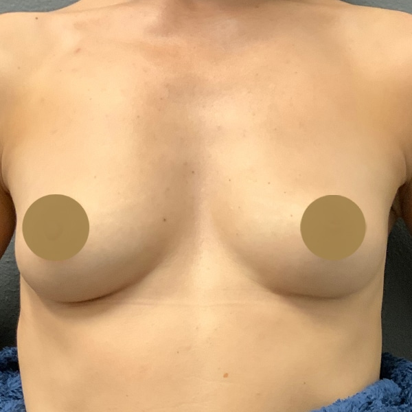 Before Vampire Breast Lift