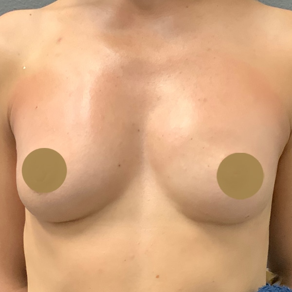 After Vampire Breast Lift