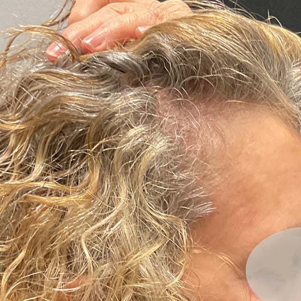 After Nonsurgical Hair Restoration