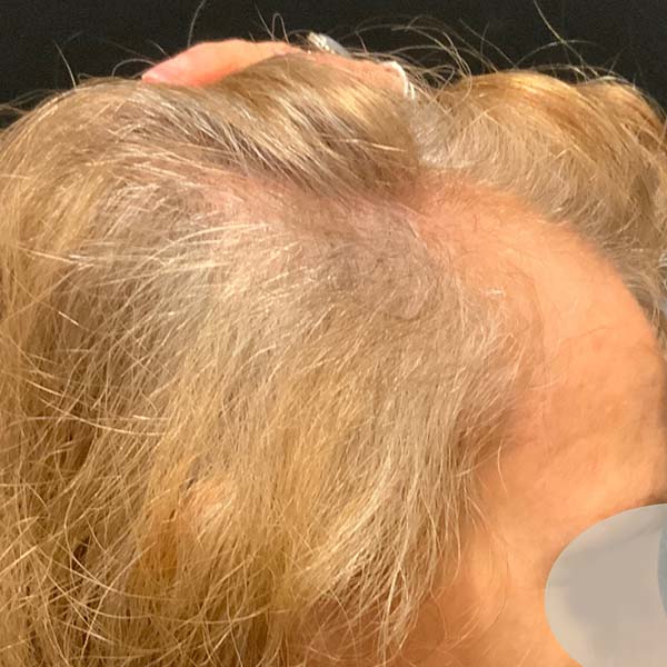 Before Nonsurgical Hair Restoration