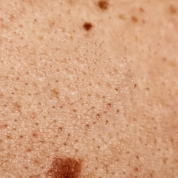 After Mole Removal after
