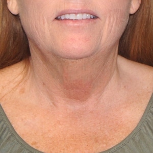 After PDO thread lift Patient is thrilled to have a tighter neck after her first PDO thread treatment.