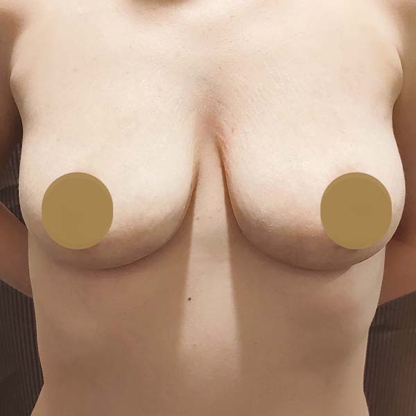 After Vampire Breast Lift