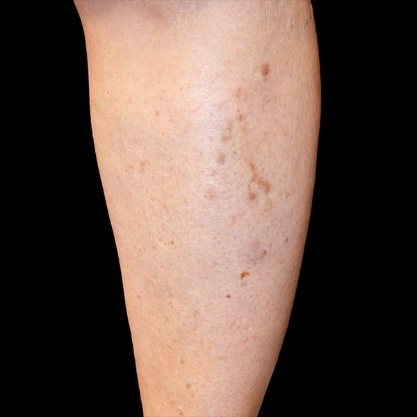 After Sclero After Sclerotherapy