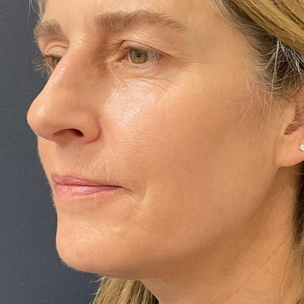 Sculptra after photo