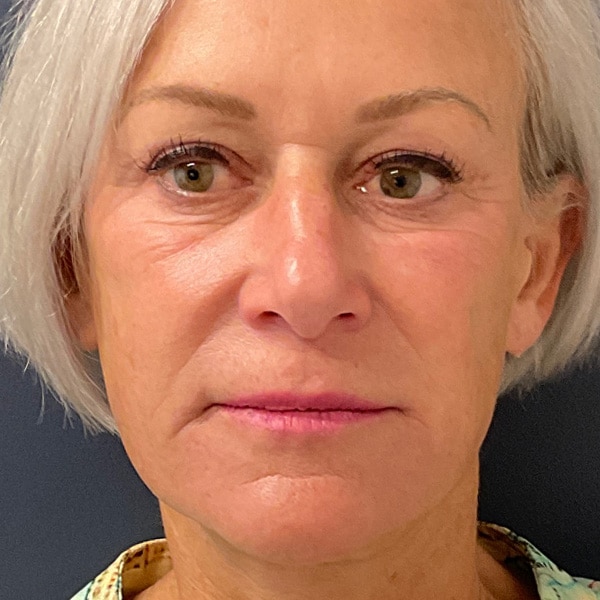 sulptra - after treatment
