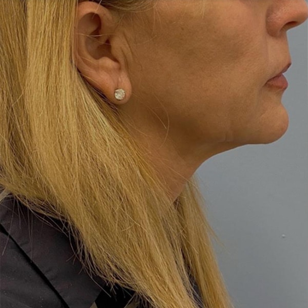 After Sofwave | RejuvenationMD | Seattle | Bellingham | Burlington after