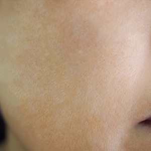 After hypergigmentation after hyperpigmentation