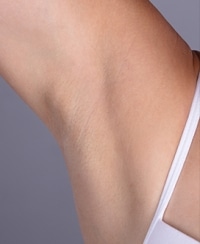Laser Hair Removal Before and After | After Picture Laser Hair Removal Before and After | After Picture