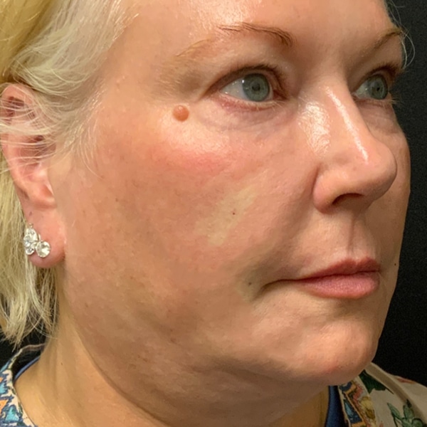 After Nonsurgical Facelift